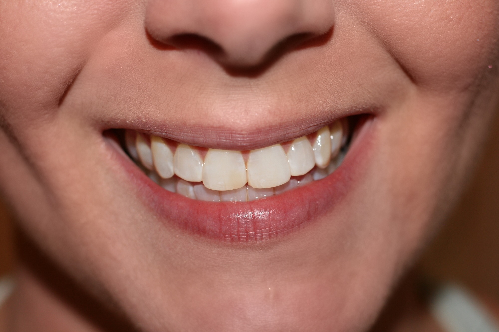 before photo teeth whitening, smile brilliant, giveaway